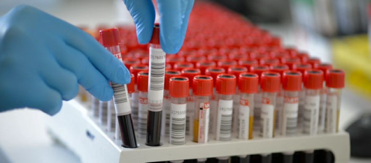 Diagnóstico precoce de tromboembolismo venoso em doentes com cancro